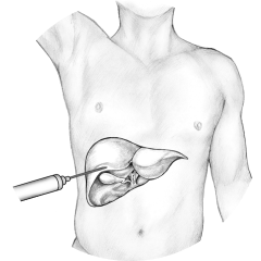 ercp